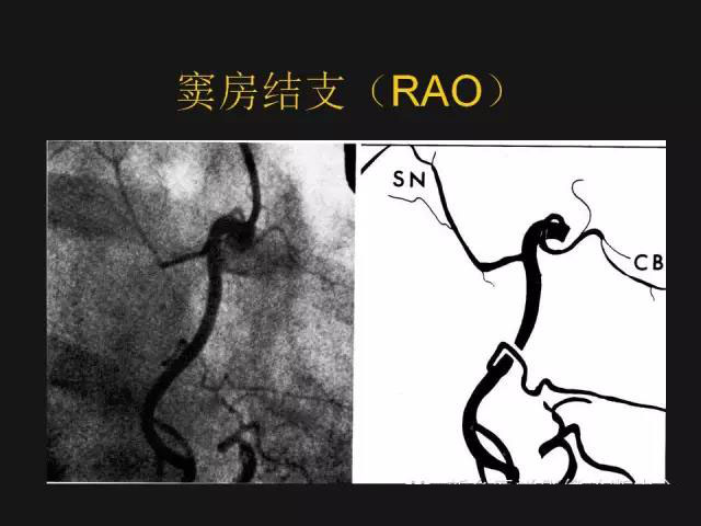 冠状动脉解剖——精细到每一个分支