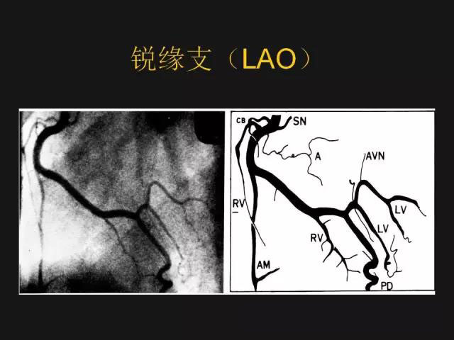 冠状动脉解剖——精细到每一个分支