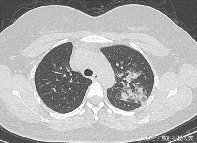 年轻貌美的女白领,减肥,咯血,ct发现了什么? - 即时医疗